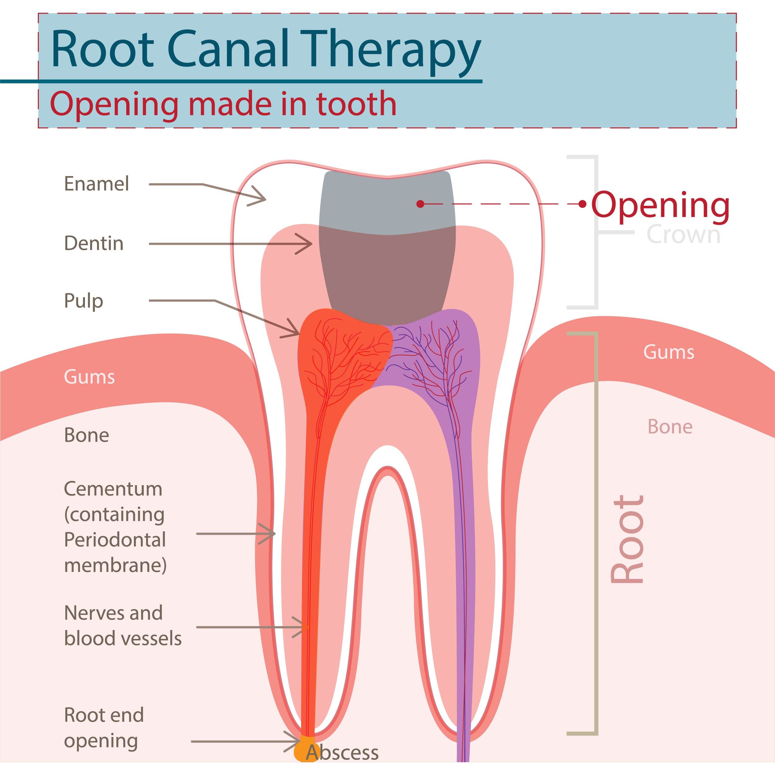 what-exactly-happens-during-a-root-canal-reno-nv